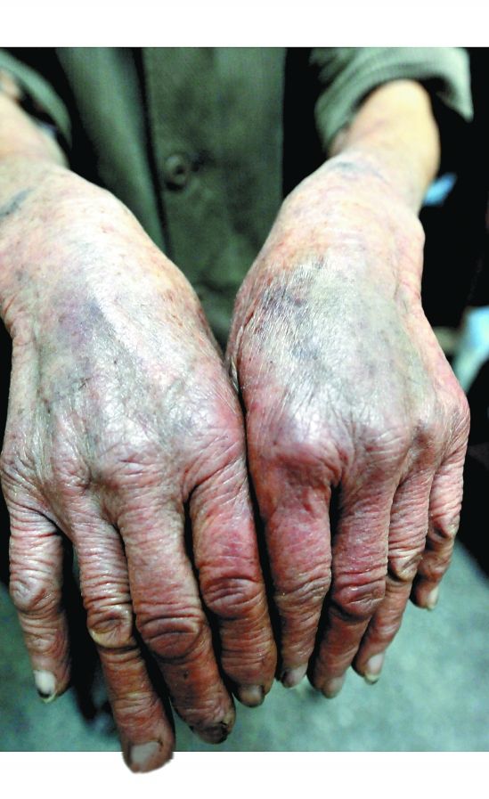 寧波2位七旬老人因拒絕搬遷遭拆遷方毆打