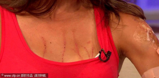 美女冠軍遭黑熊襲擊 帶傷講述搏斗過程(圖)